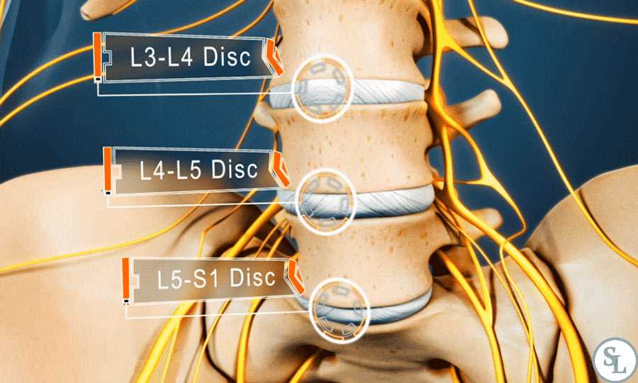 Грыжа межпозвонкового диска L5 S1 — причины, симптомы, методы лечения — что нужно знать
