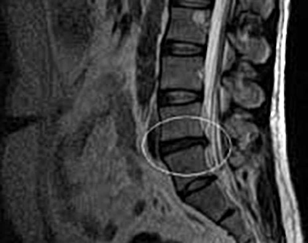 Диагностика грыжи межпозвонковых дисков при остеохондрозе