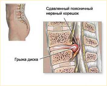 Хирургическое лечение остеохондроза грыжи межпозвонкового диска