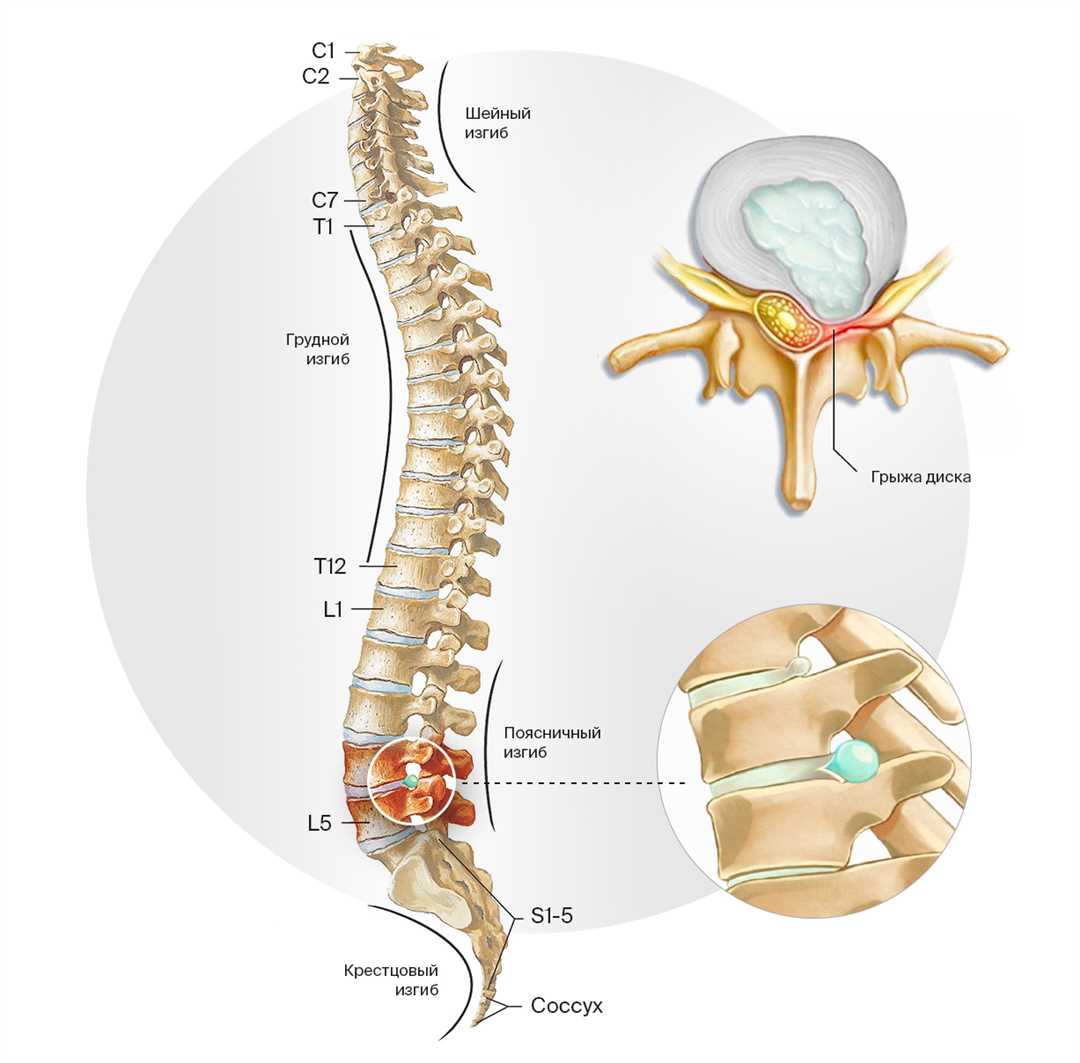 Остеохондроз грыжа межпозвонкового диска — опасное заболевание спины — симптомы, причины и эффективное лечение